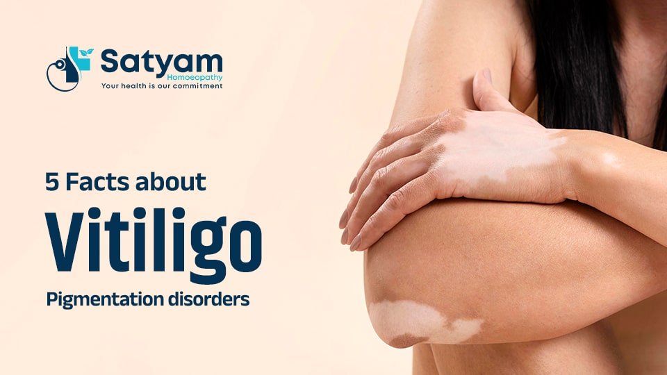Home 3 5 Facts about Vitiligo