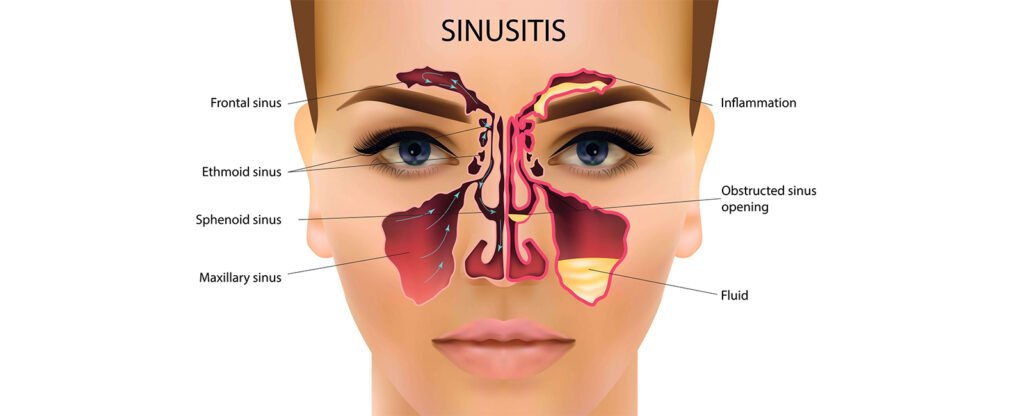 Online Homeopathic Treatment for Sinusitis - Satyam Homeopathy .